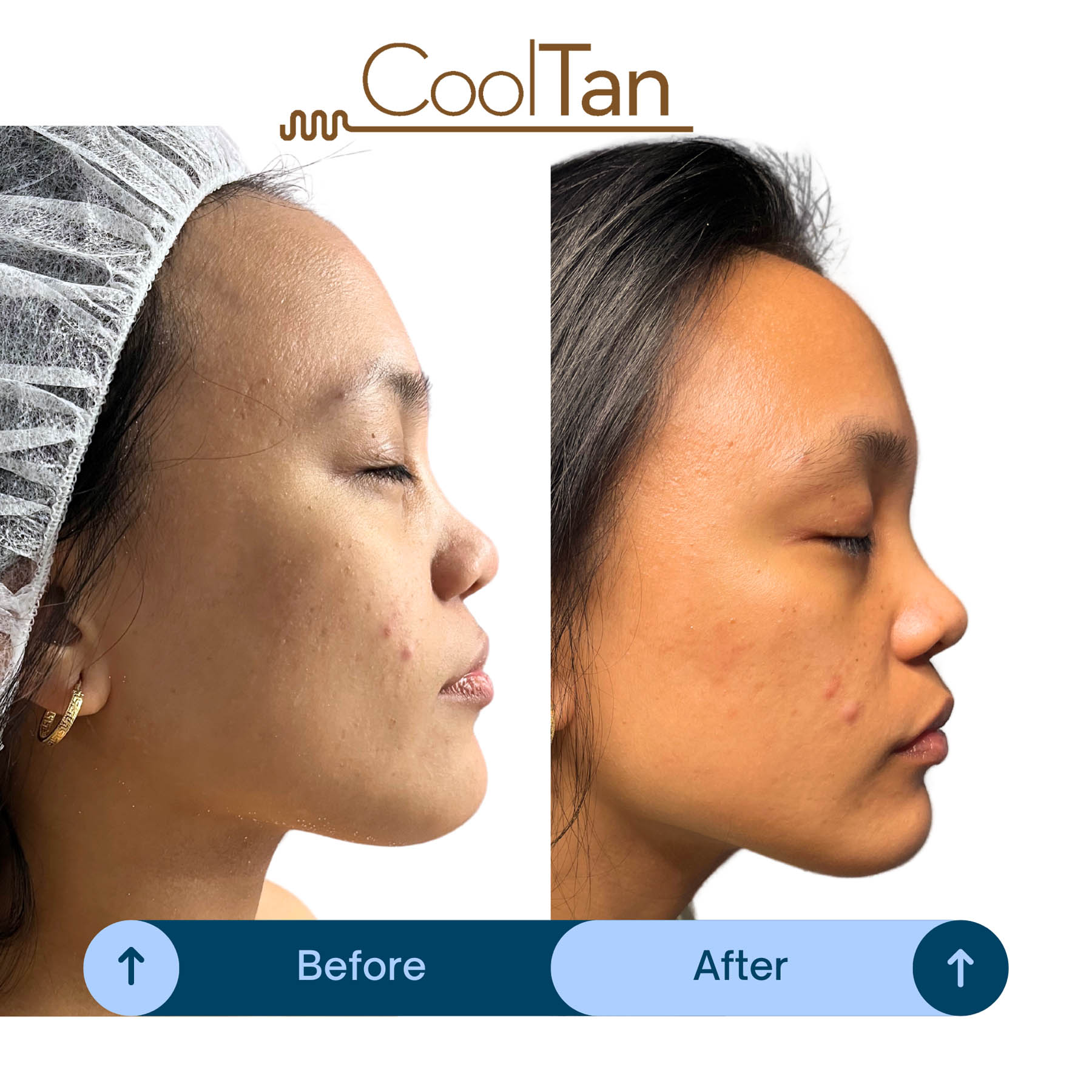 Before and after coolifting