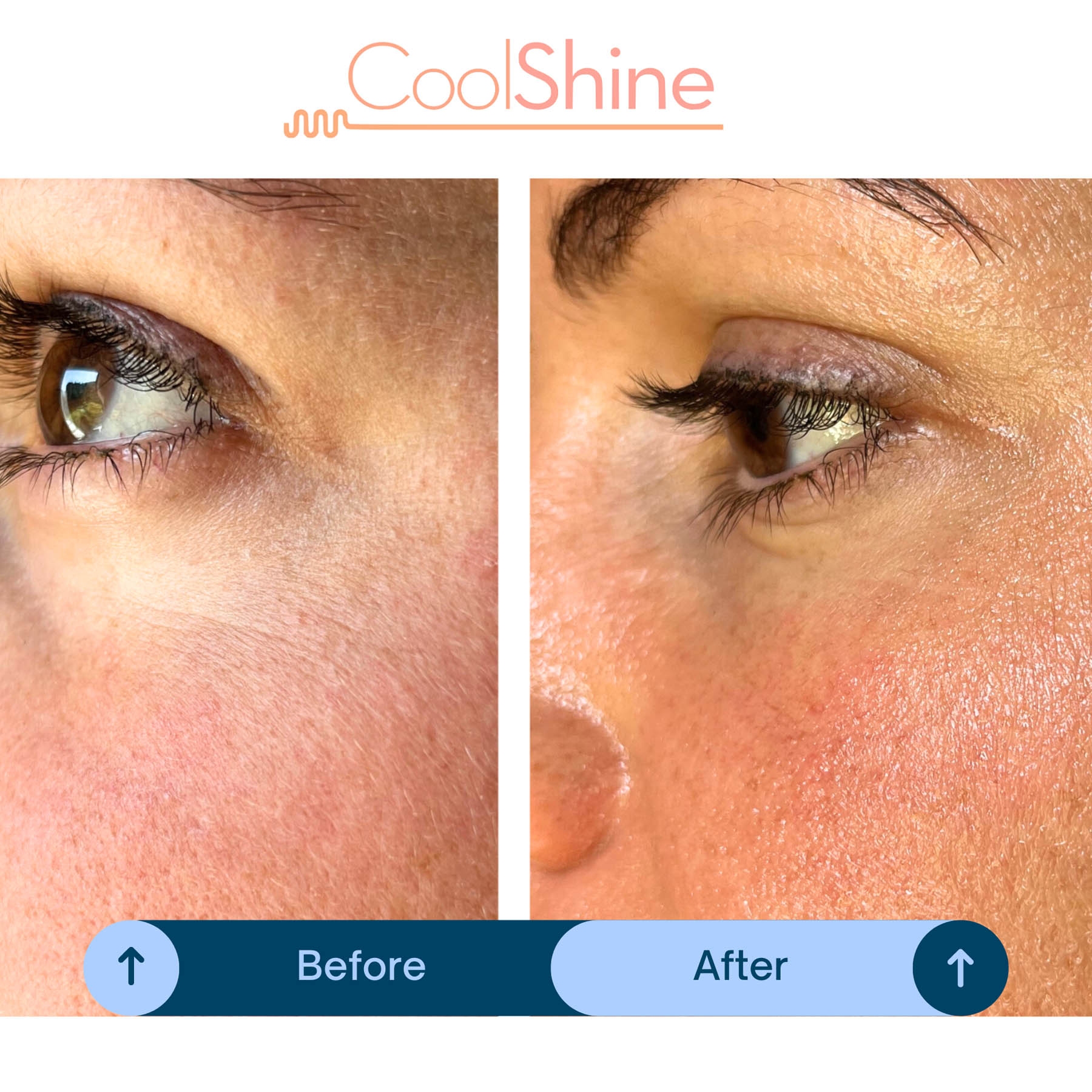 Before and after coolifting