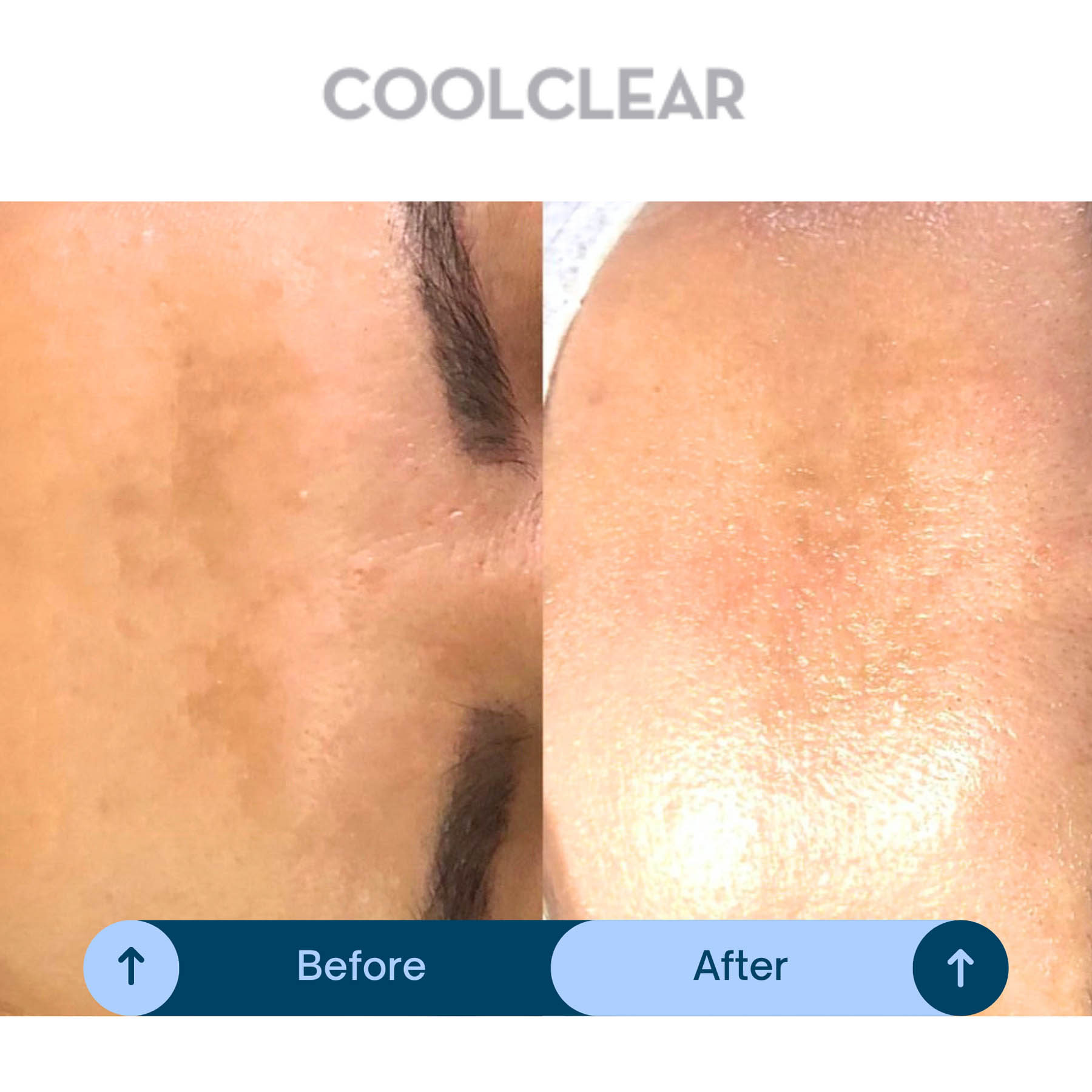 Before and after coolifting