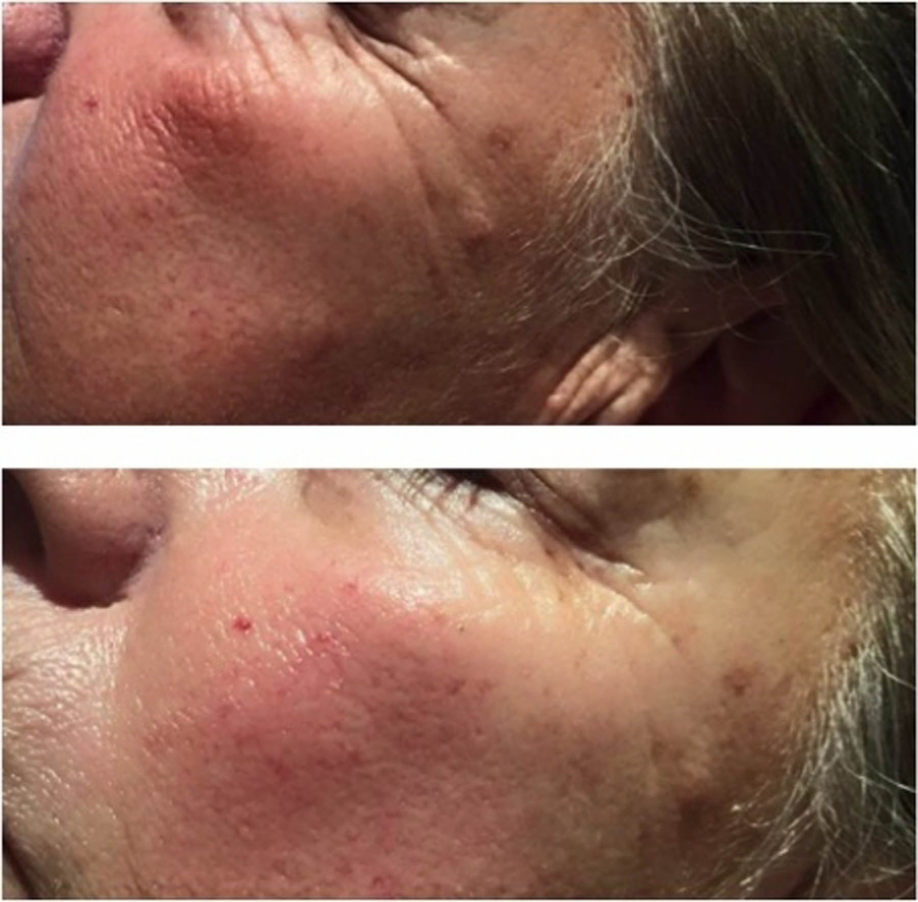 Before and after coolifting