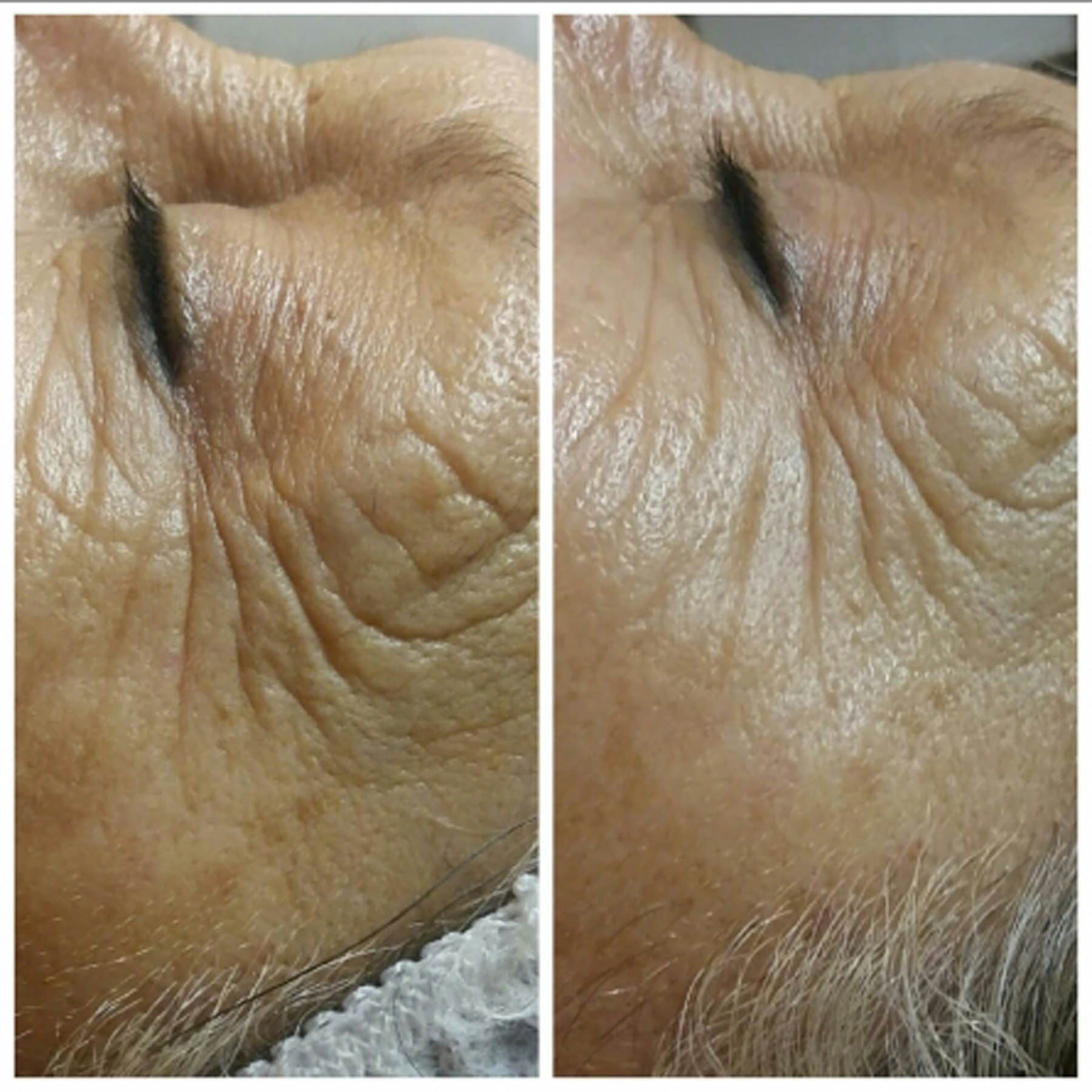 Before and after coolifting