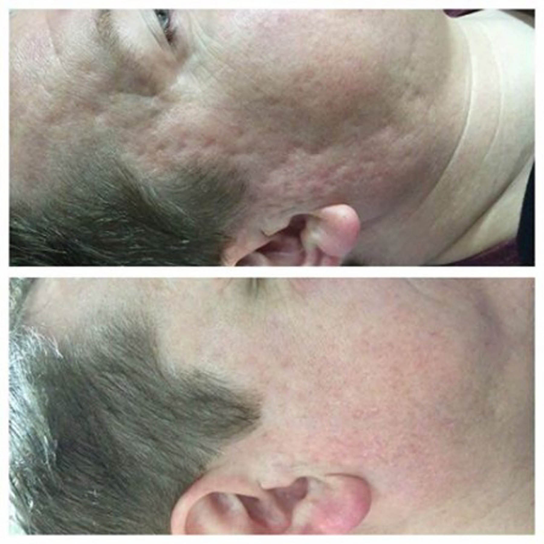 Before and after coolifting