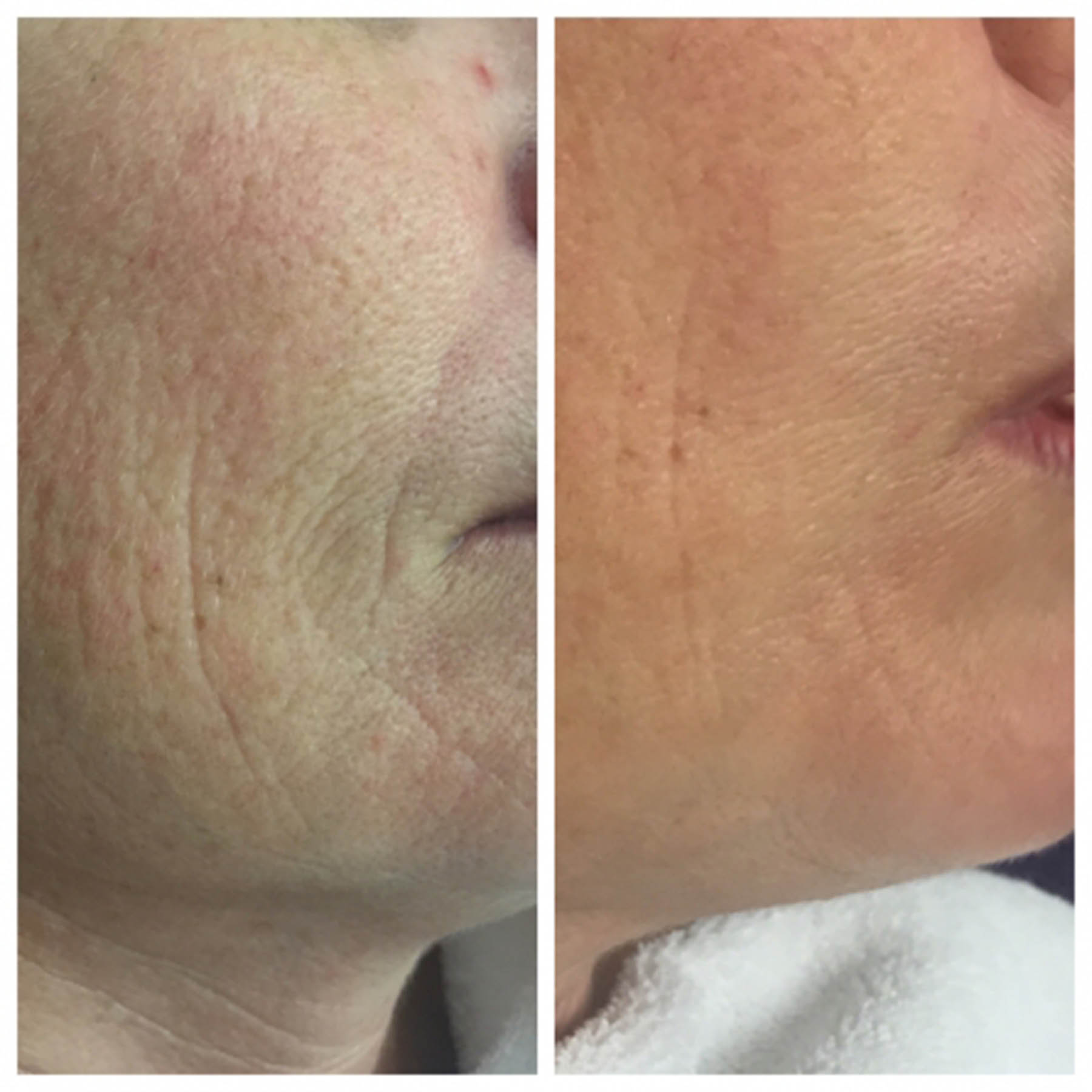 Before and after coolifting
