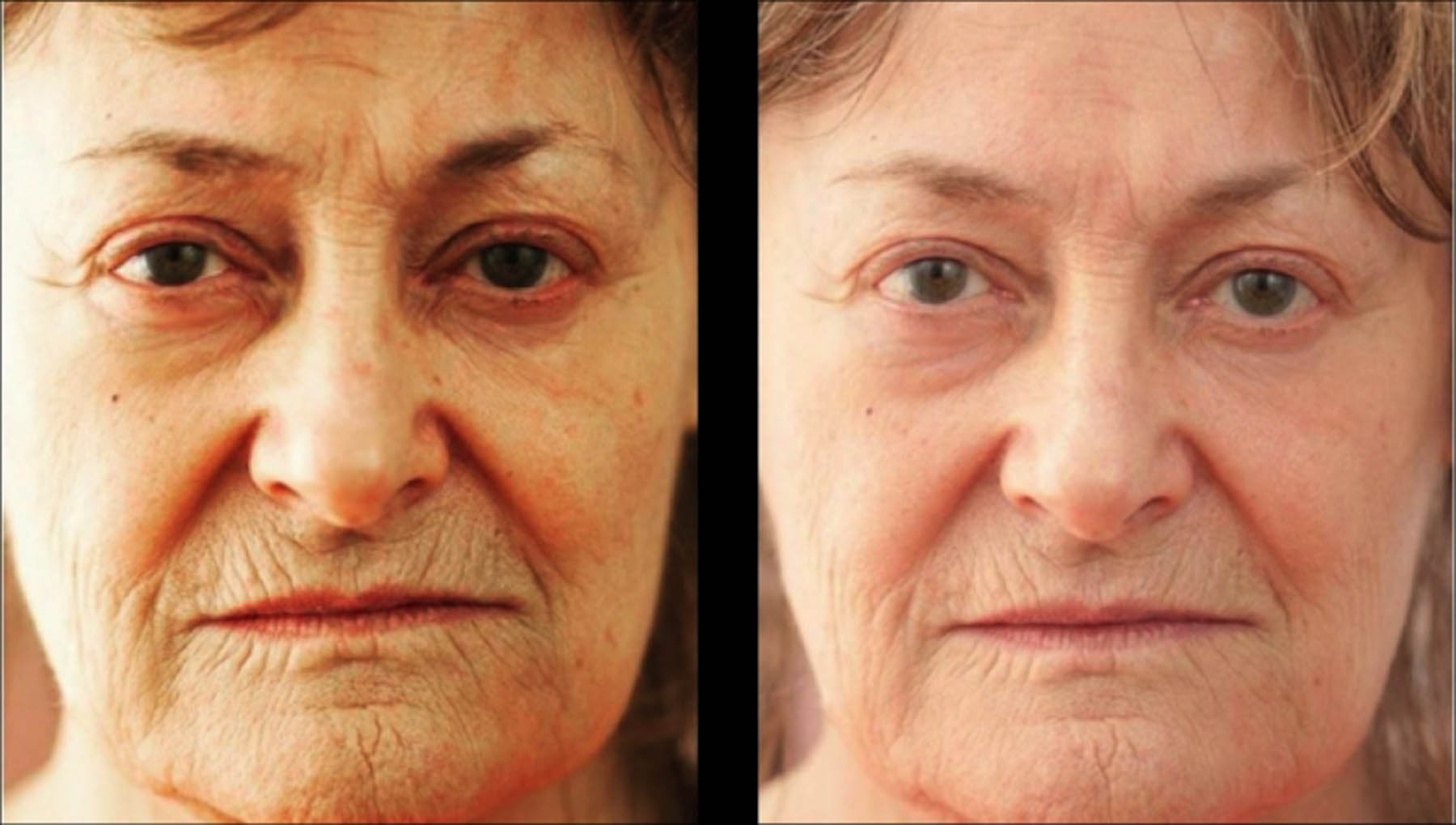 Before and after coolifting