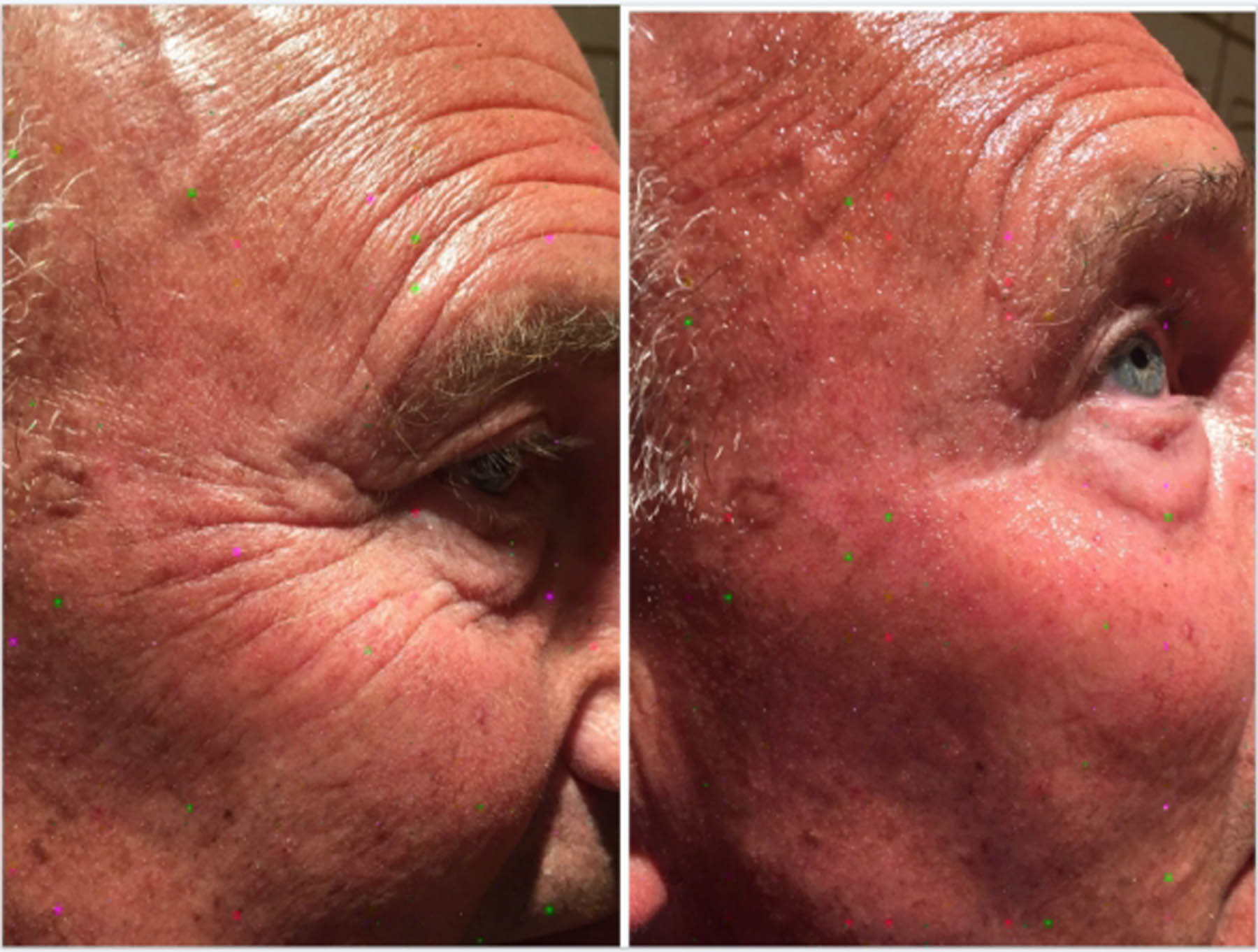 Before and after coolifting