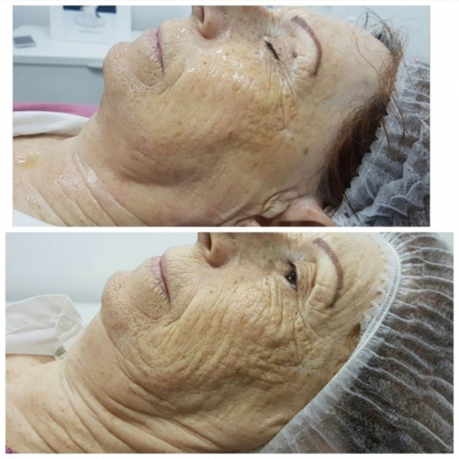 Before and after coolifting