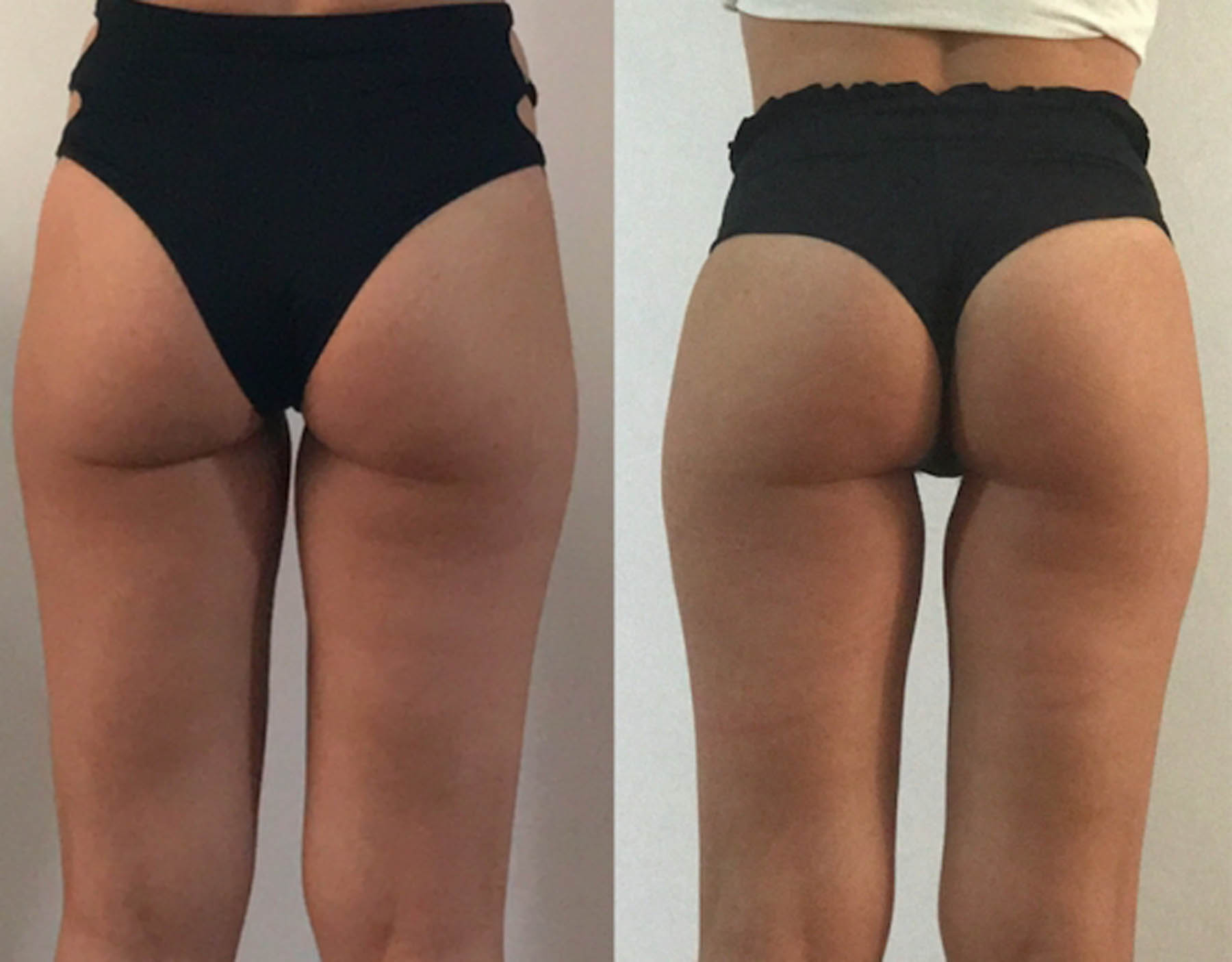 Before and after coolifting