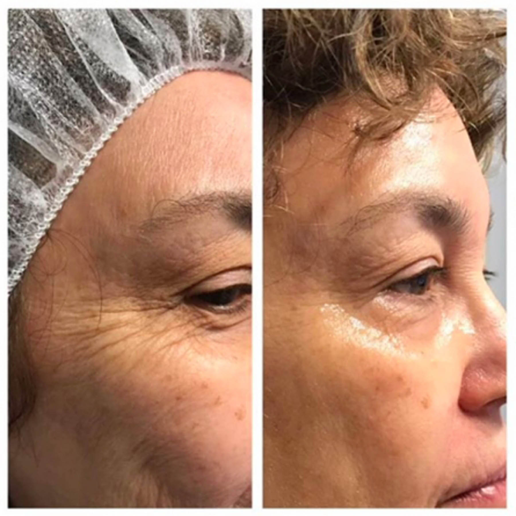 Before and after coolifting