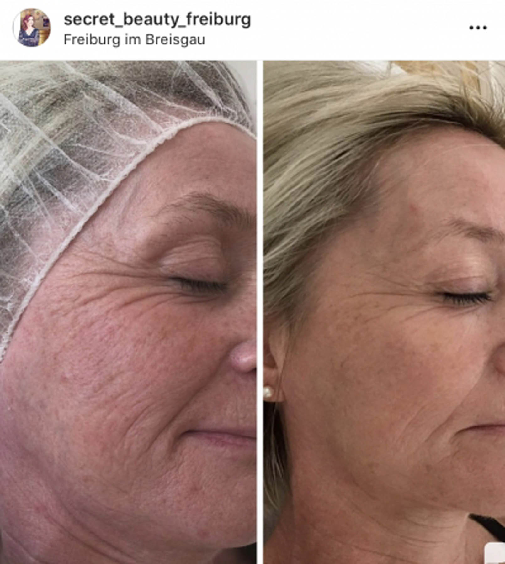 Before and after coolifting