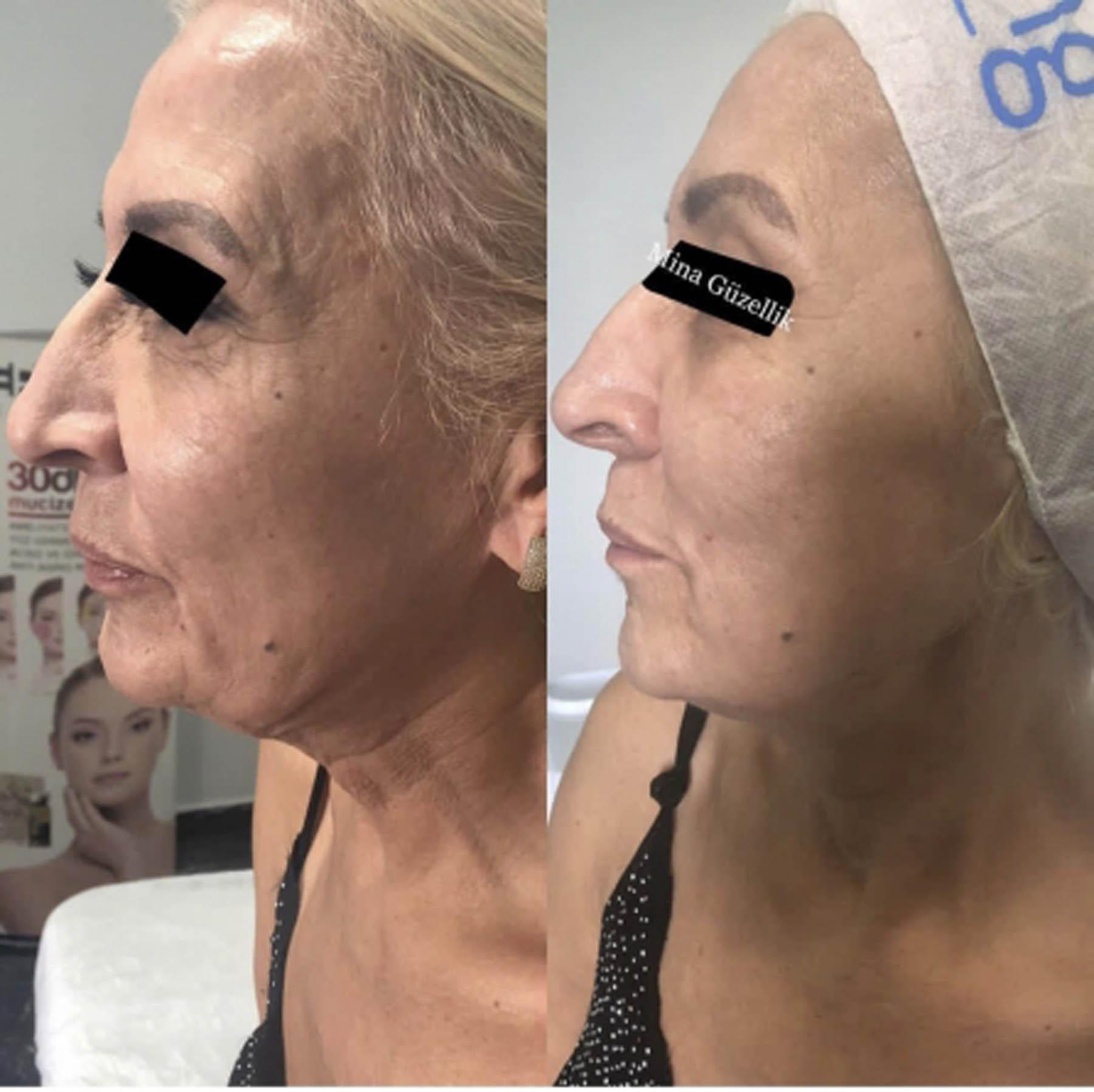 Before and after coolifting
