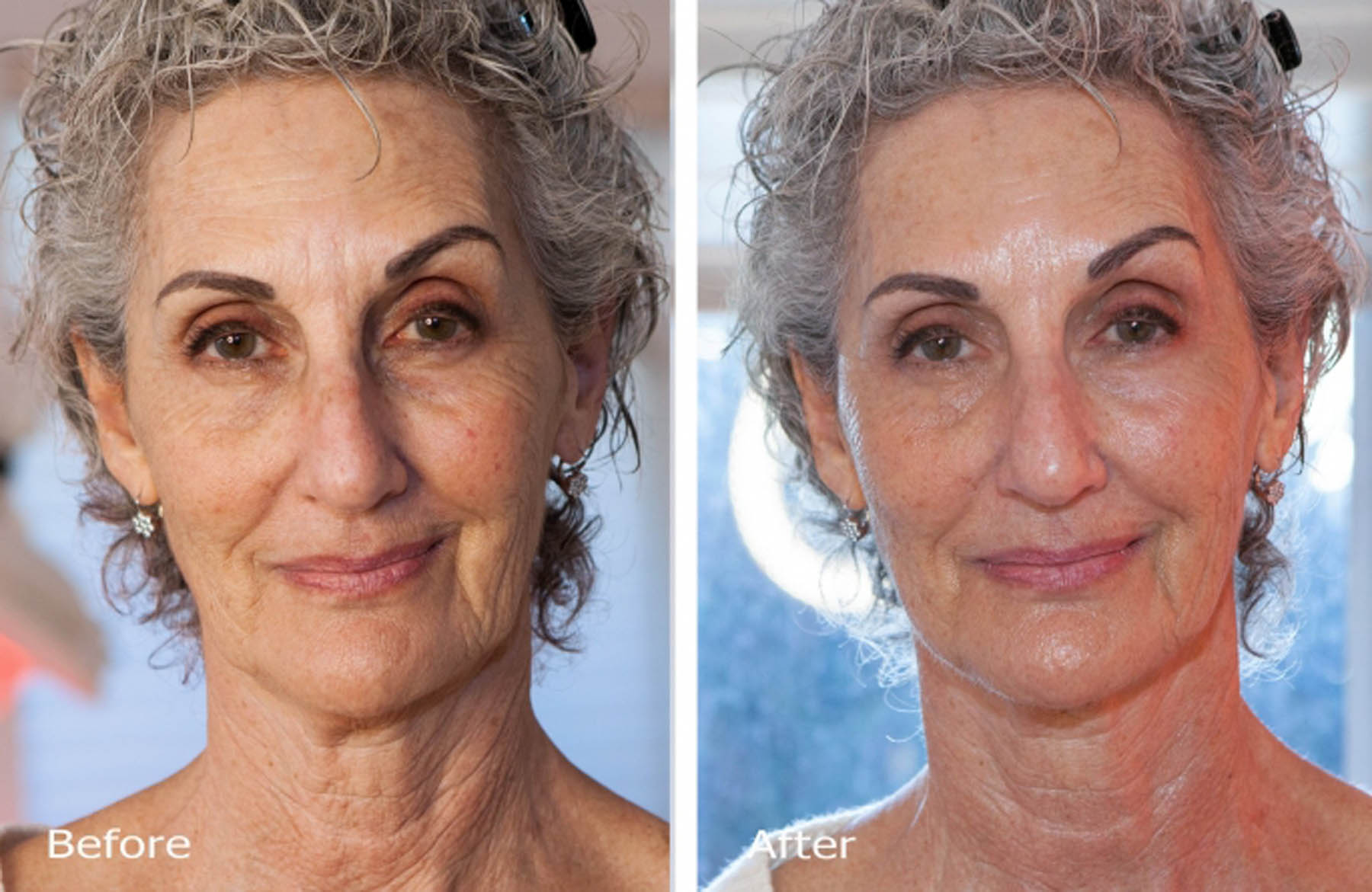 Before and after coolifting